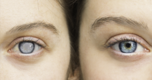 Glaucoma: Early Symptoms, Causes, and Treatment Options