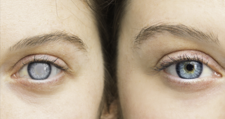 Glaucoma: Early Symptoms, Causes, and Treatment Options